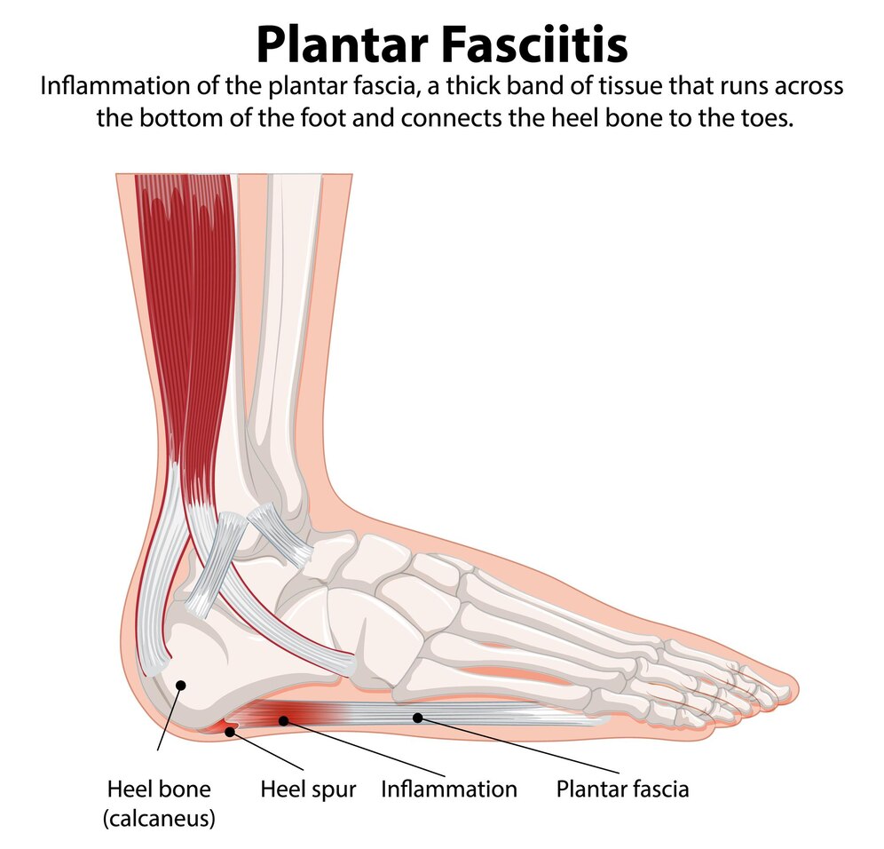 plantar fasciitis foot anatomy illustration 1308 169806